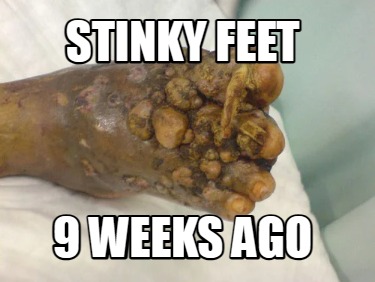stinky-feet-9-weeks-ago